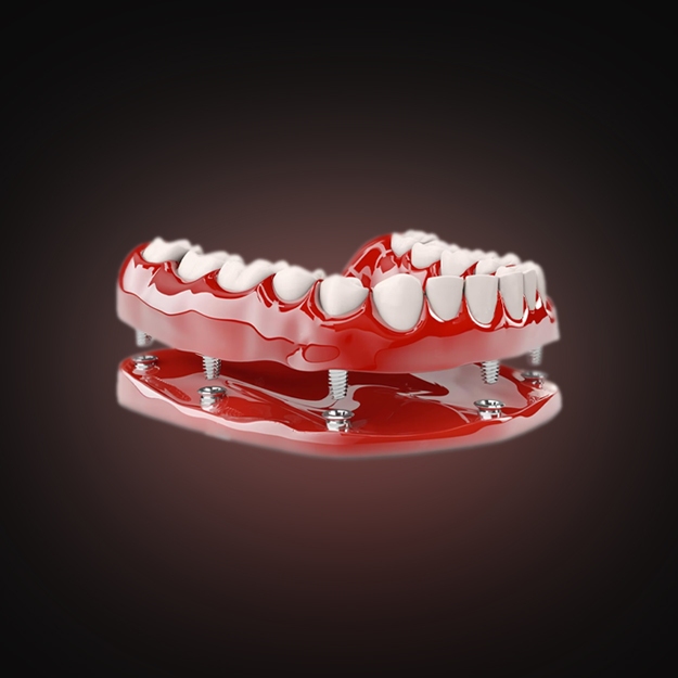 Implantes