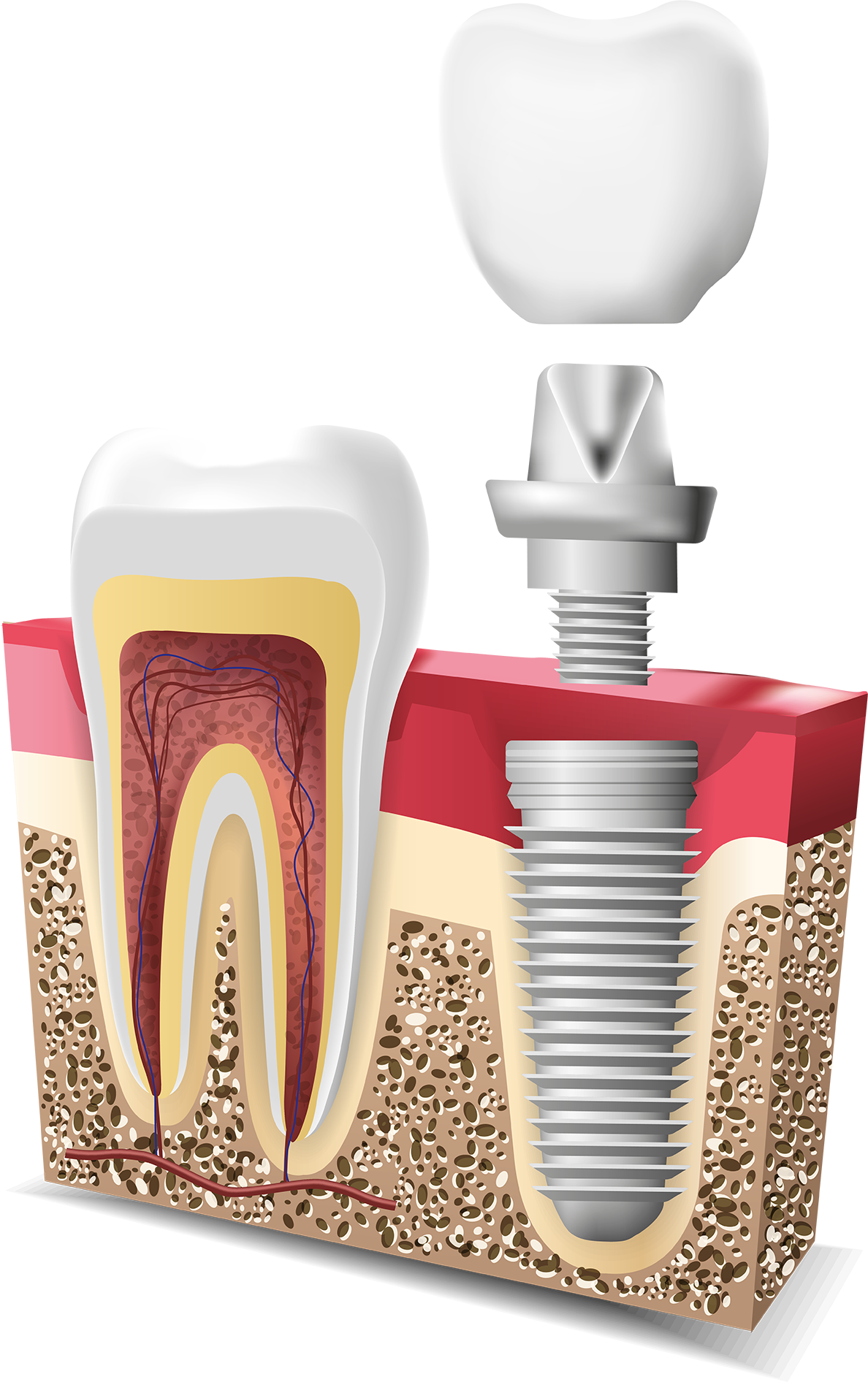 Implantes